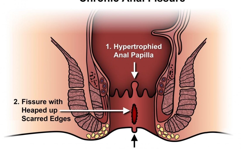 Makat Çatlağı Belirtileri